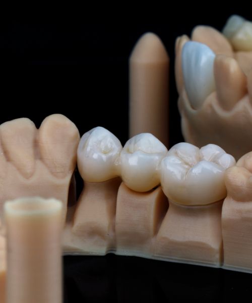 Puente realizado en Laboratorio Peña dental