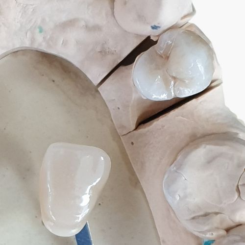 Corona con incrustación realizada en el Laboratorio protésico Peña Dental