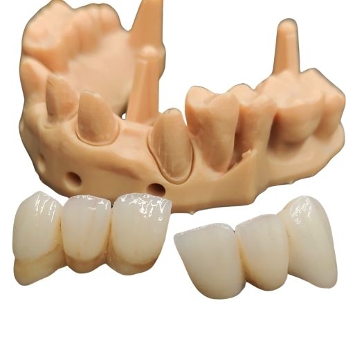 Puente de zirconio realizado por el laboratorio protésico Peña dental