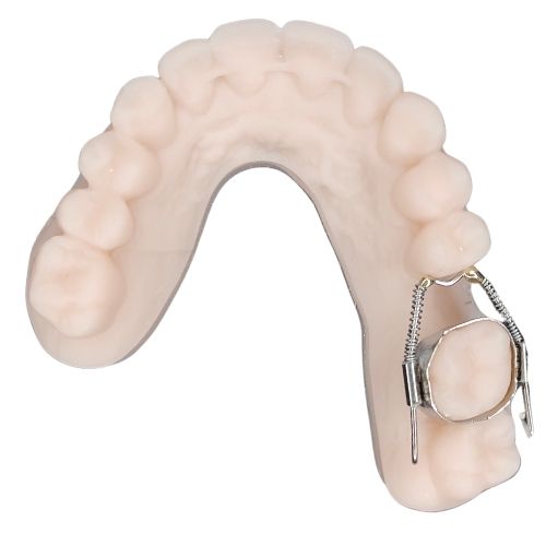 RECUPERACIÓN DE ESPACIO. ORTODONCIA FIJA LABORATORIO PEÑA DENTAL